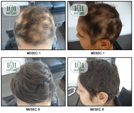 Alopecija Areata