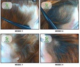 Trakciona Alopecija
