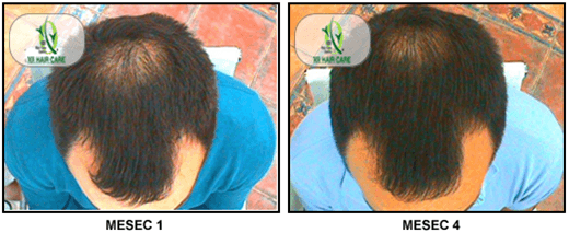 Androgena Alopecija