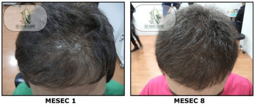 Androgena Alopecija