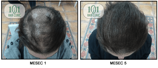 Trakciona Alopecija