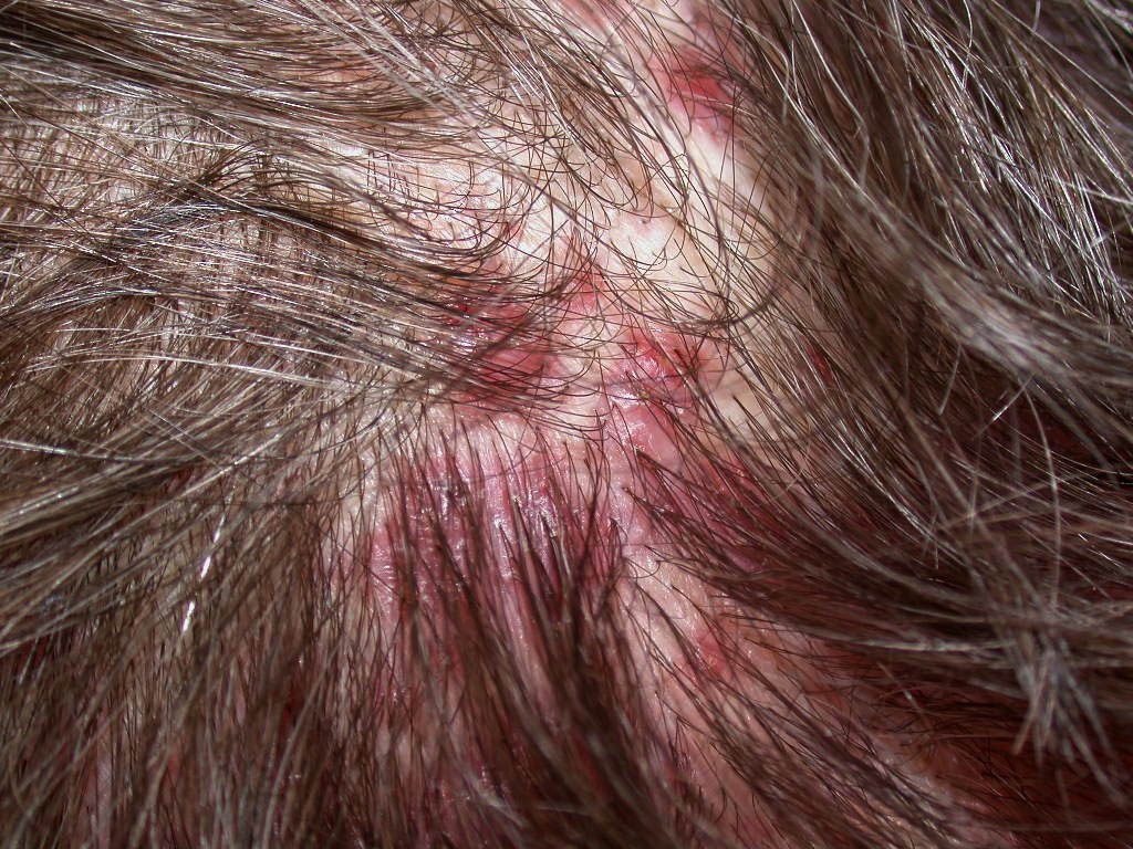 10. Antibiotics for Severe Hair Follicle Infections - wide 7