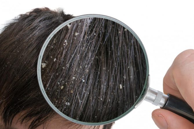 Perutanje kože glave – kako se rešiti dosadne peruti